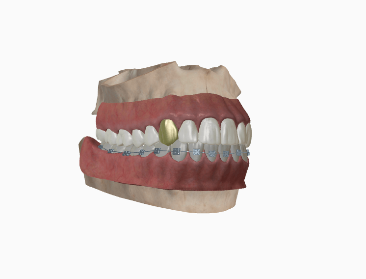 3D jaw with braces and a gold crown
